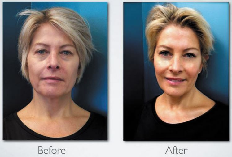 celluma-aging-before-and-after