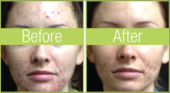celluma-acne-before-and-after